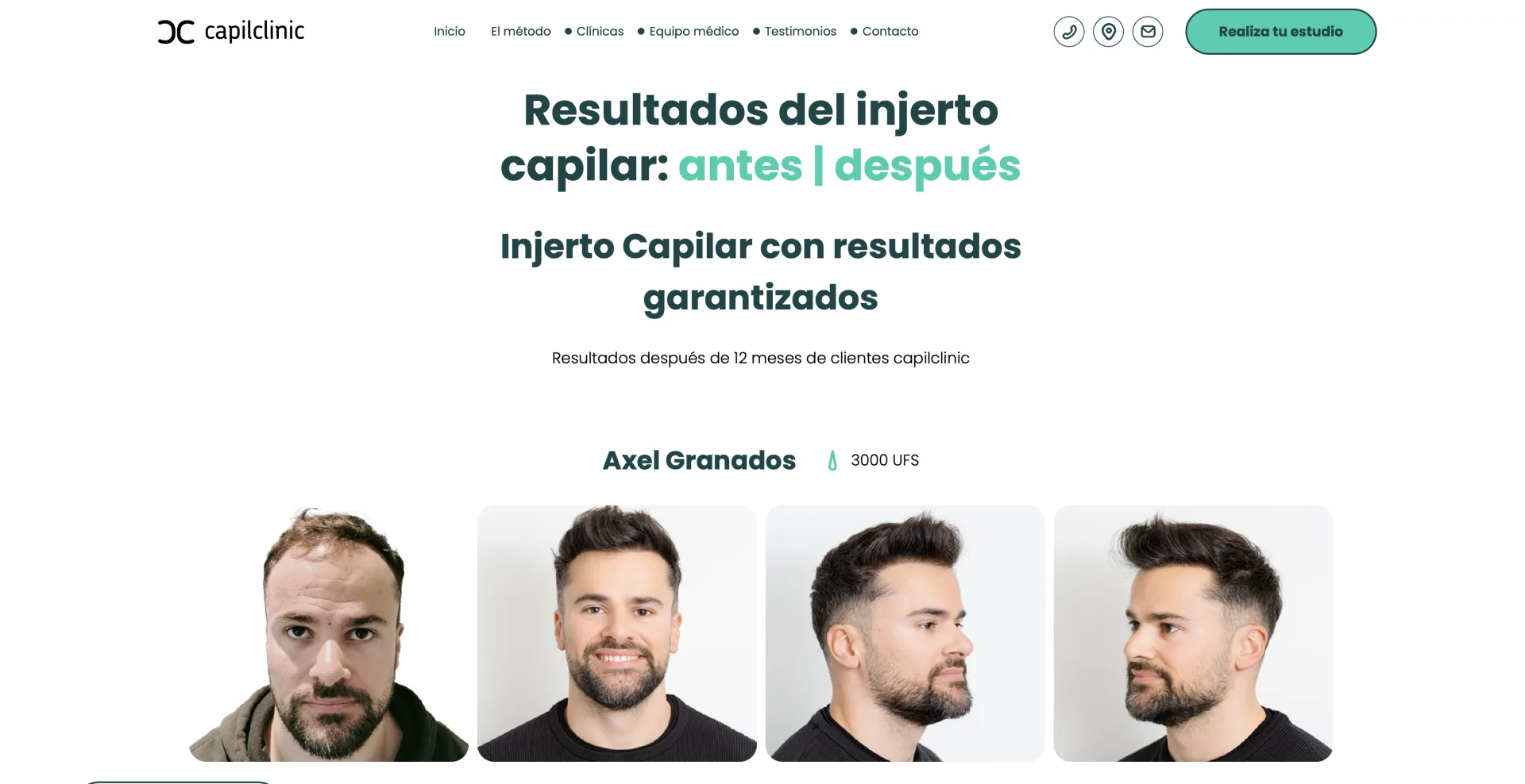 Resultados antes y después de pacientes reales de Capilclinic